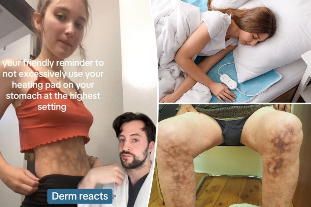 Dangerous side effect of heating pads
